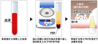 PRP再生療法