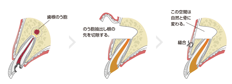 歯根端切除術