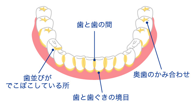 磨き残しやすいところ