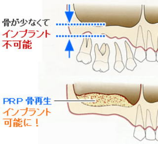 骨が少なくてインプラントができないといわれた方へ