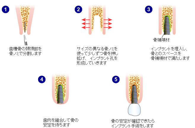 歯槽堤分割術（スプリットクレスト）